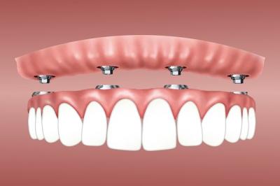 implant dentaire - dentiste paris 17